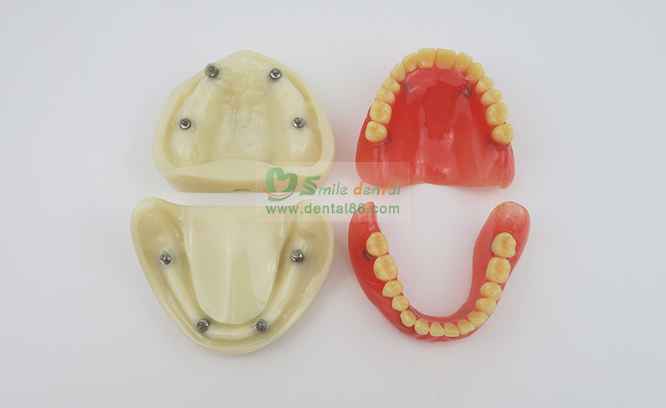 Full Denture Implant Mode